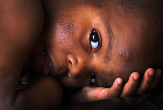 Sincere Smith, un niño de 2 años de Flint, Michigan, sufre de un sarpullido en todo el cuerpo que su madre atribuyó al agua municipal con la que él se bañó. Las medidas de reducción de costos en Flint llevaron a agua contaminada que contenía plomo y otras toxinas.