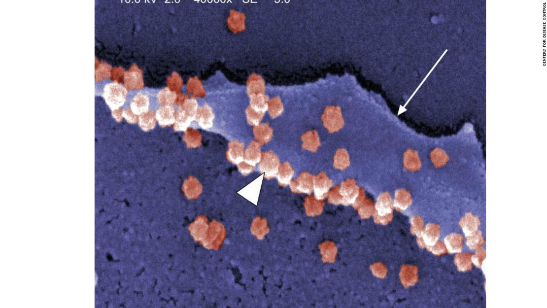 El virus del SARS, un coronavirus como el resfriado común, se muestra en rosa en esta imagen de micrografía electrónica de los Centros para el Control de Enfermedades.