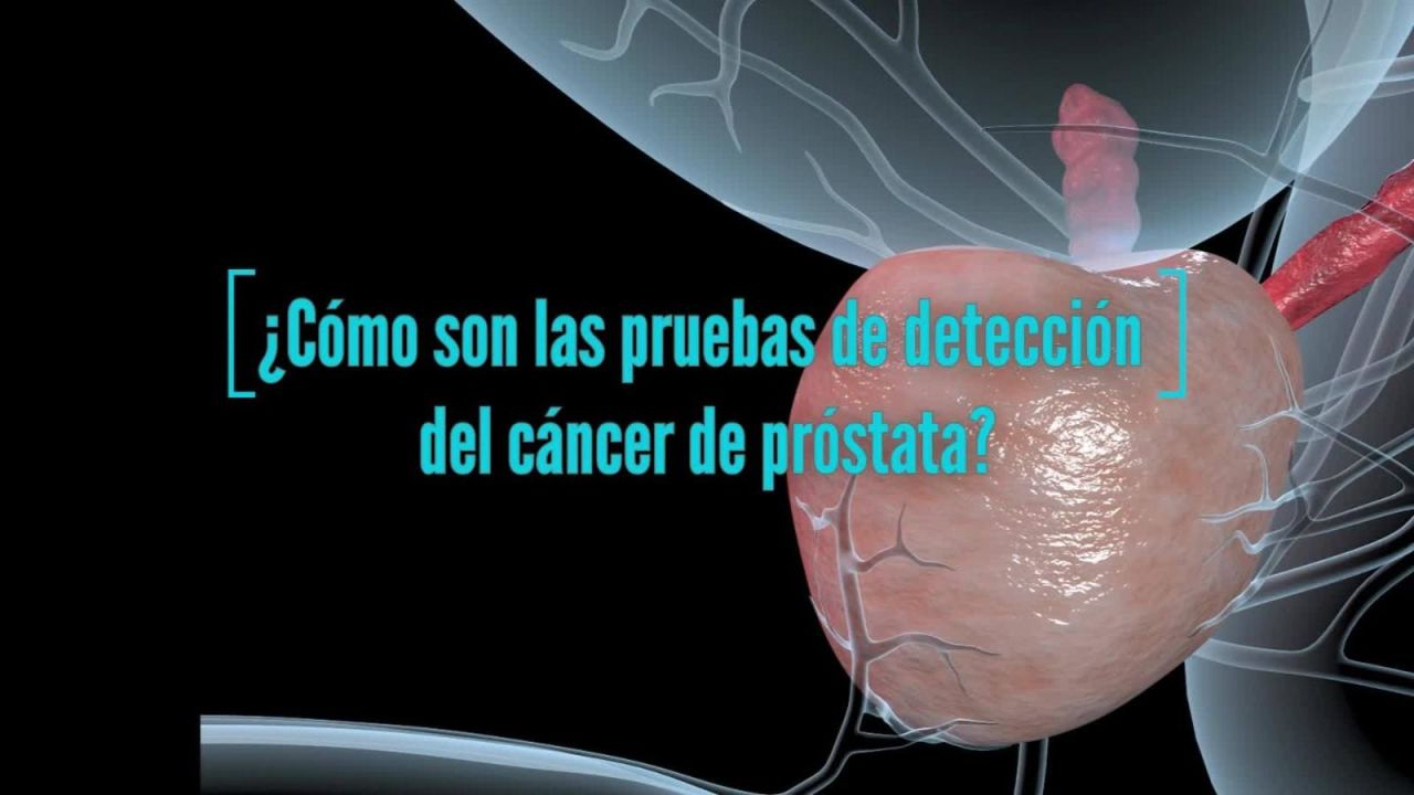 CNNE 762035 - la deteccion temprana del cancer de prostata salva vidas