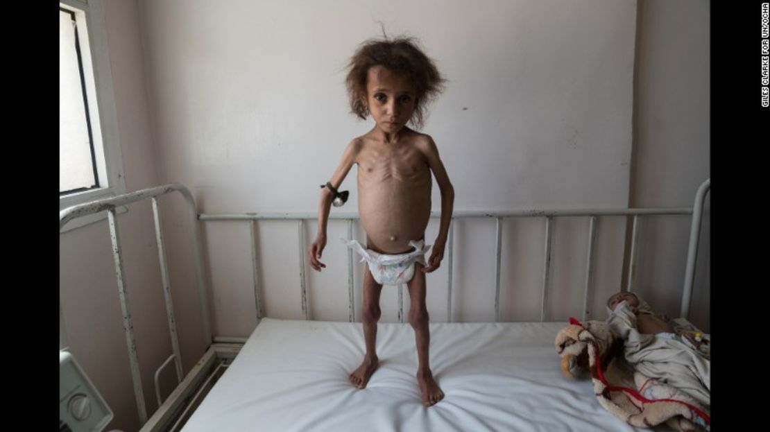 CNNE 83fdd38a - 170619132624-02-yemen-civil-war-malnutrition-exlarge-169