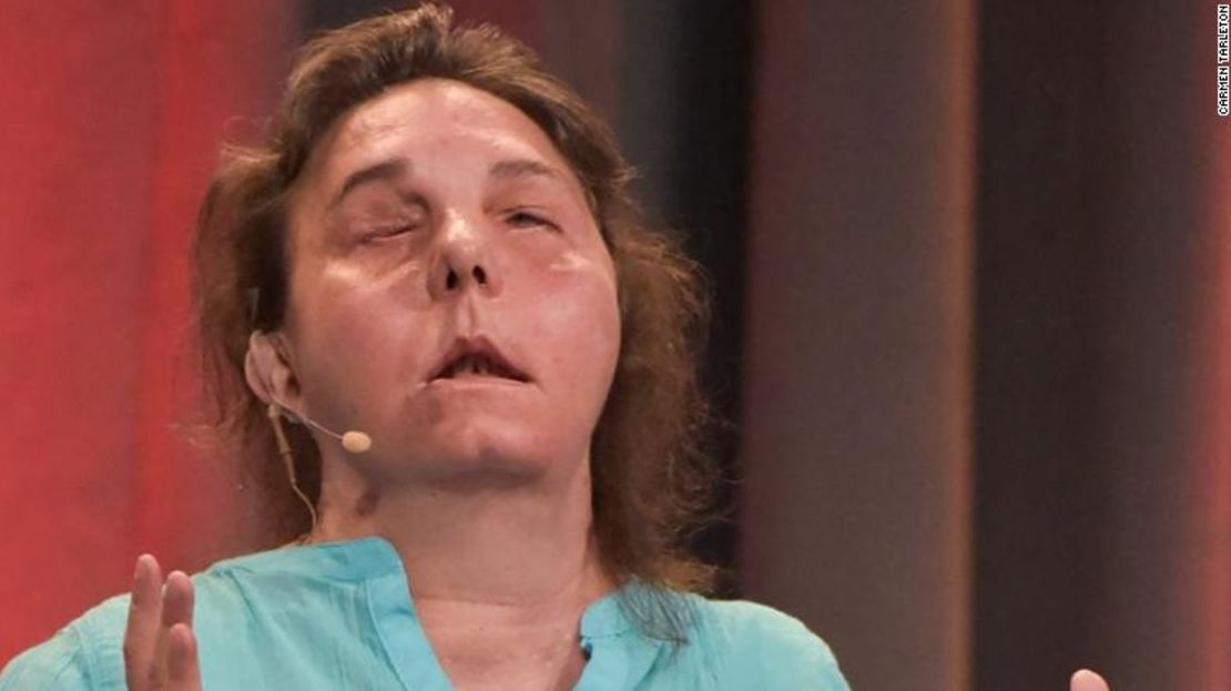 CNNE 873008 - trasplante-cara-face-transplant-rejection-exlarge-169