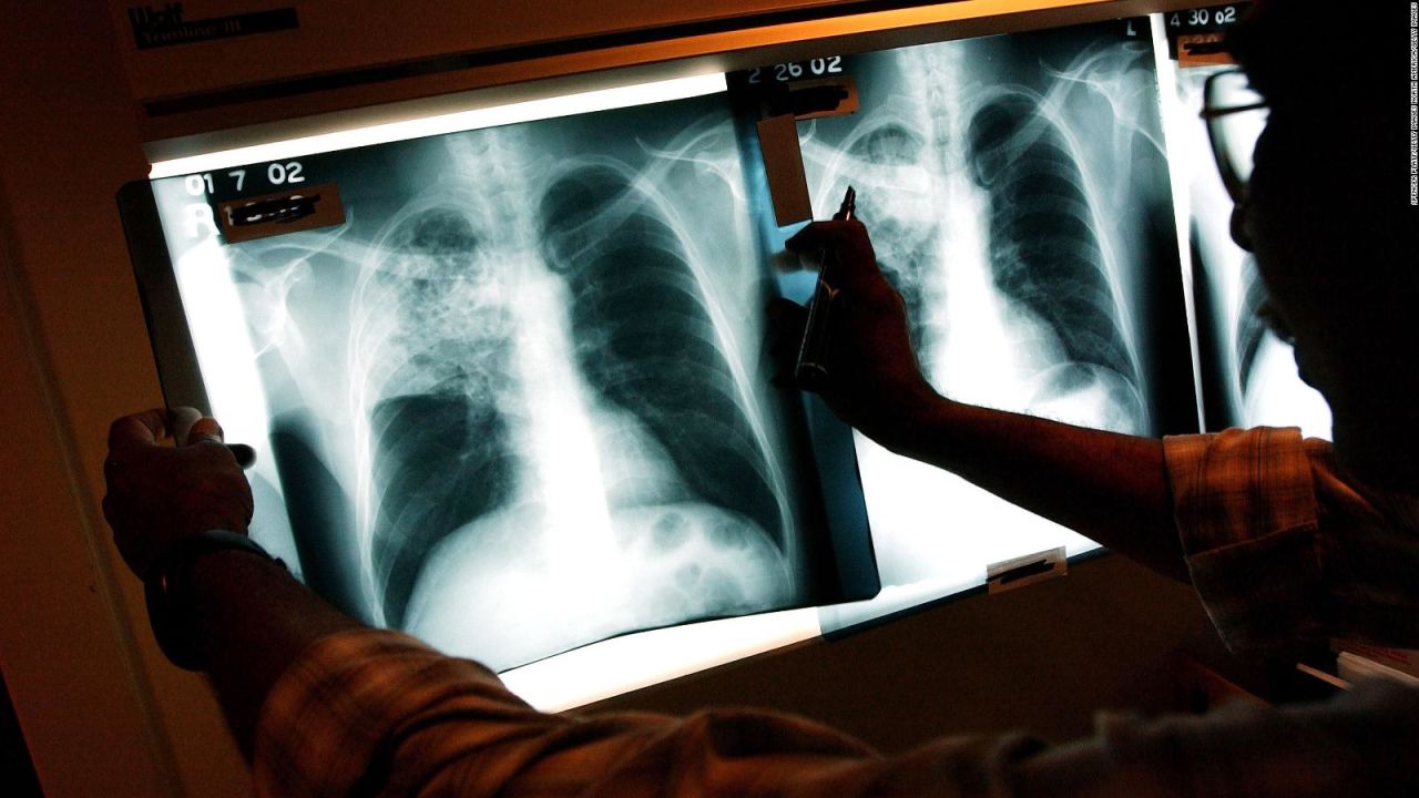 CNNE 970285 - los paises mas afectados por la tuberculosis en el mundo