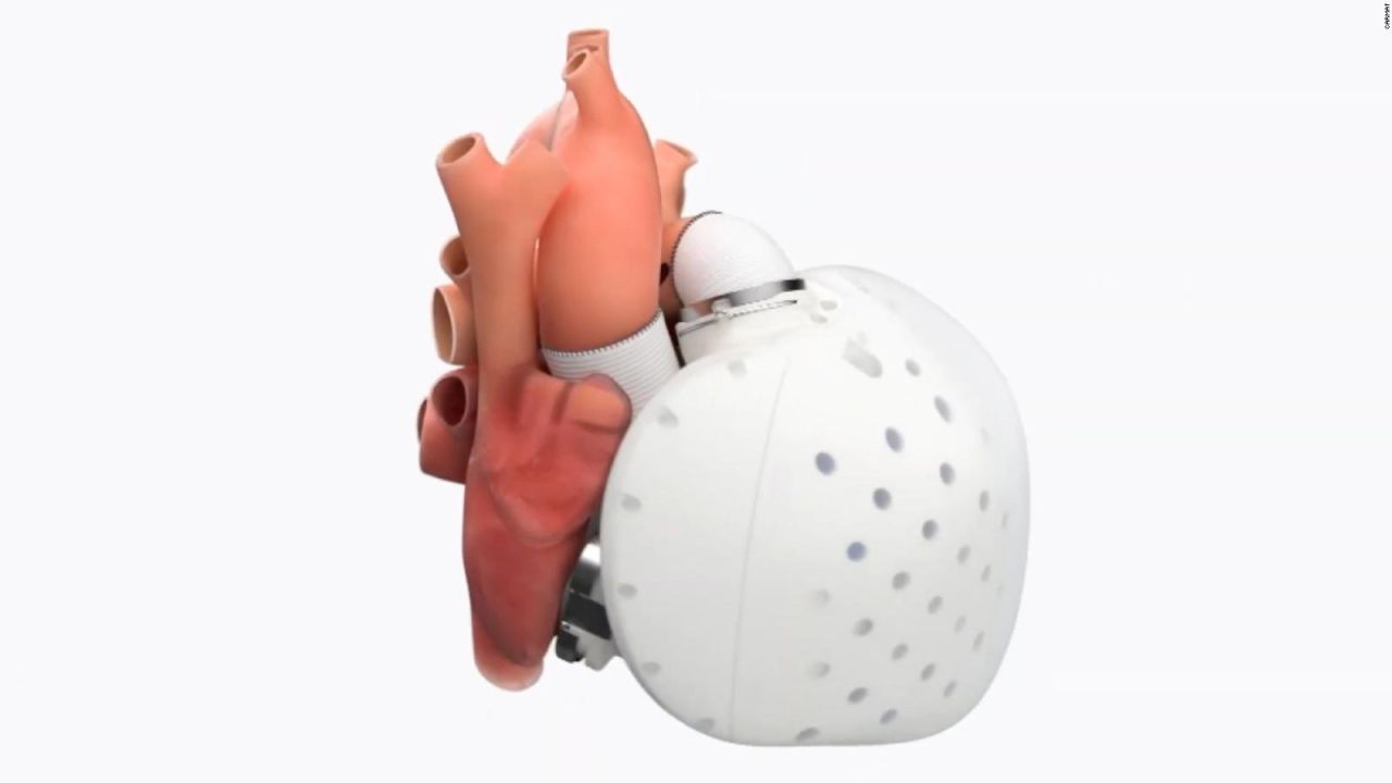 CNNE 970676 - este nuevo corazon artificial responde a pacientes