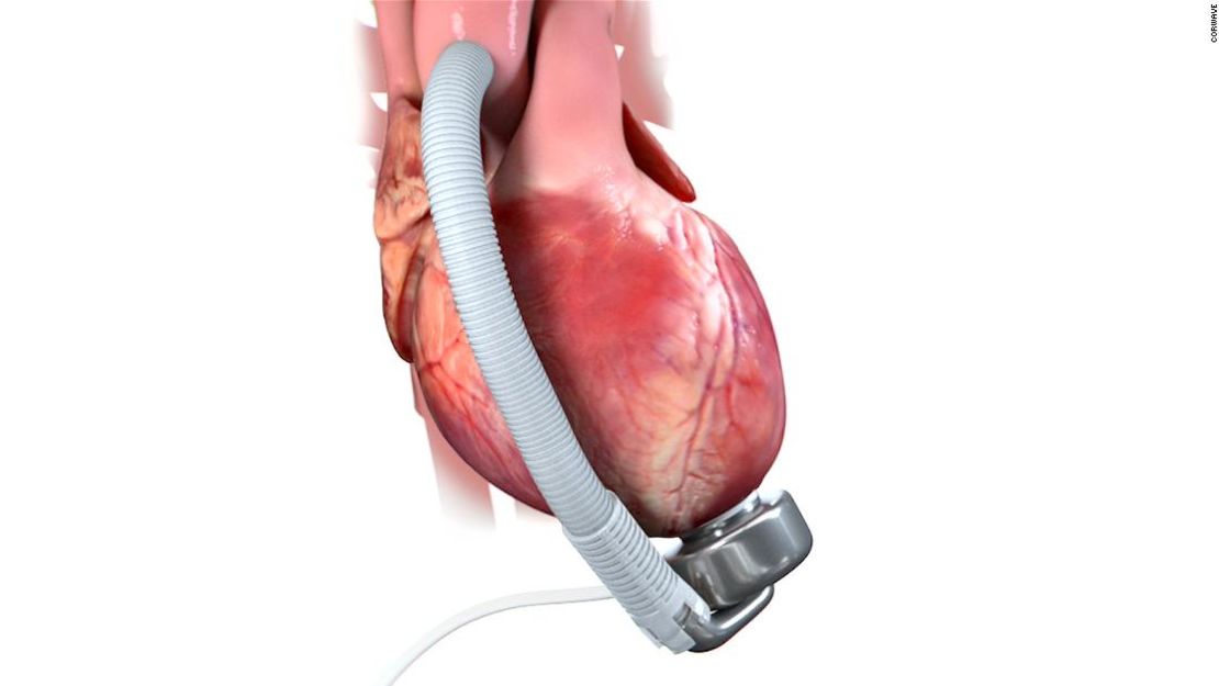 El "dispositivo de asistencia ventricular izquierda" de CorWave.