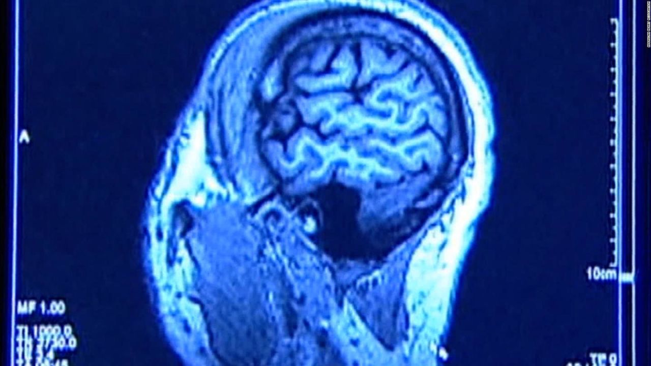 CNNE 975661 - detectan sintomas de afeccion cerebral tras covid-19