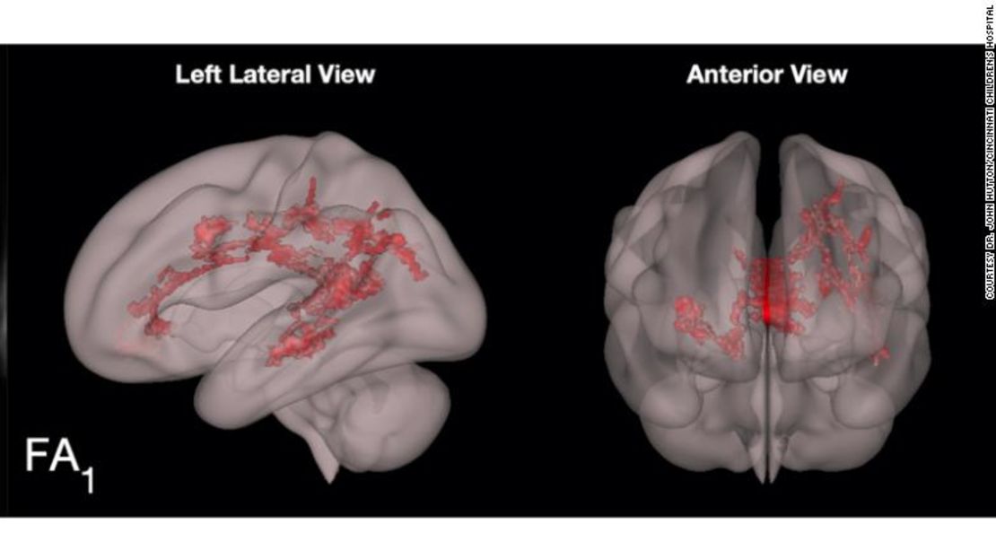 Las áreas rojas muestran el aumento en la materia blanca organizada en los centros de lenguaje del cerebro.