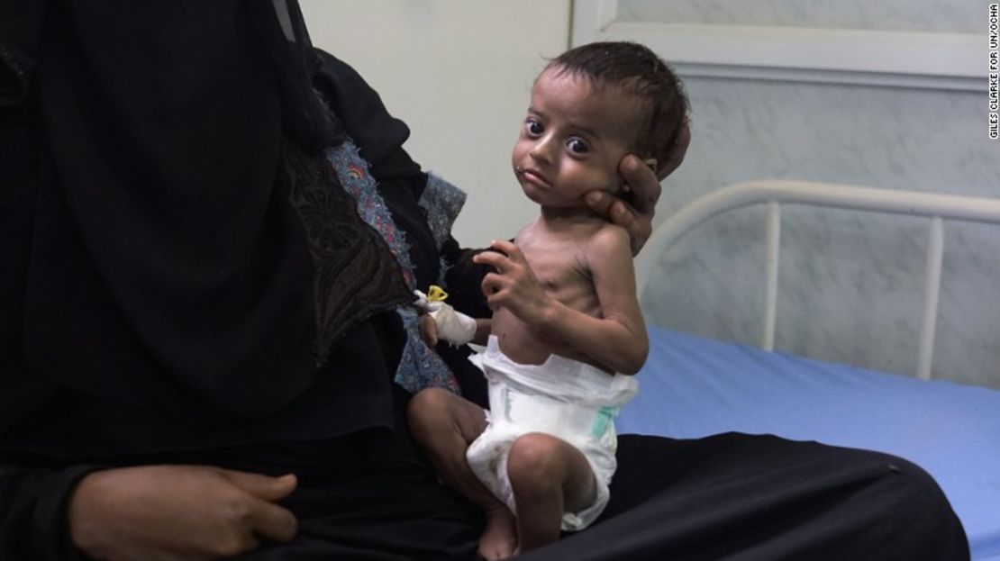 CNNE c7368a6f - 170621155659-26-yemen-civil-war-malnutrition-exlarge-169