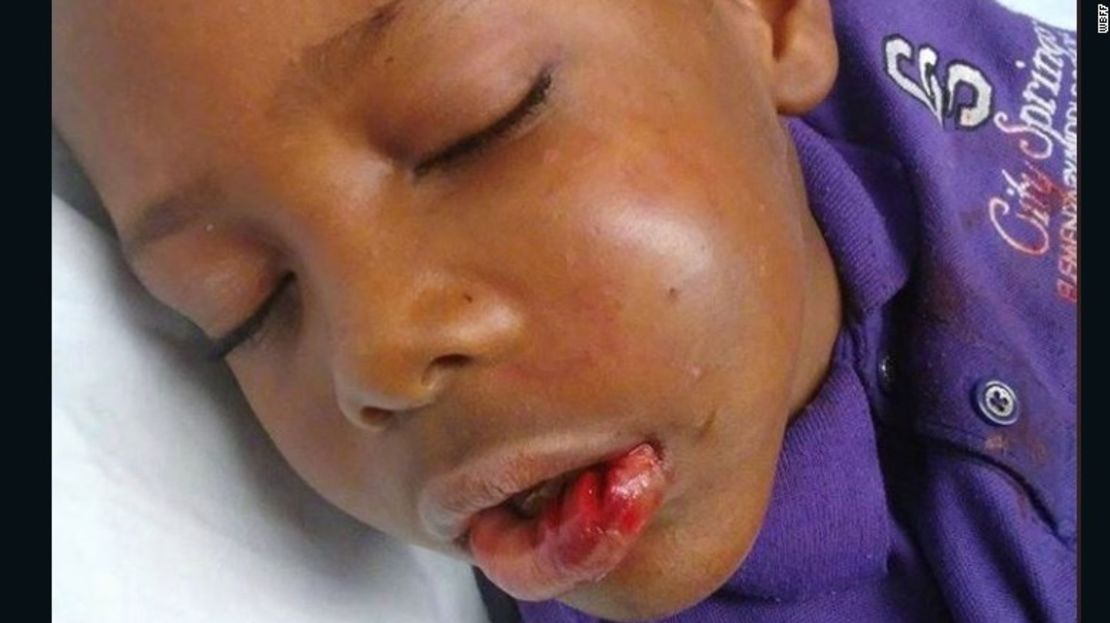 Trayvon Grayson, de 7 años, después del incidente.