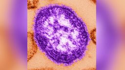 En esta imagen de los Centros para el Control y la Prevención de Enfermedades (CDC), una microscopía electrónica de transmisión revela el aspecto ultraestructural de una sola partícula vírica, o "virión", del virus del sarampión.