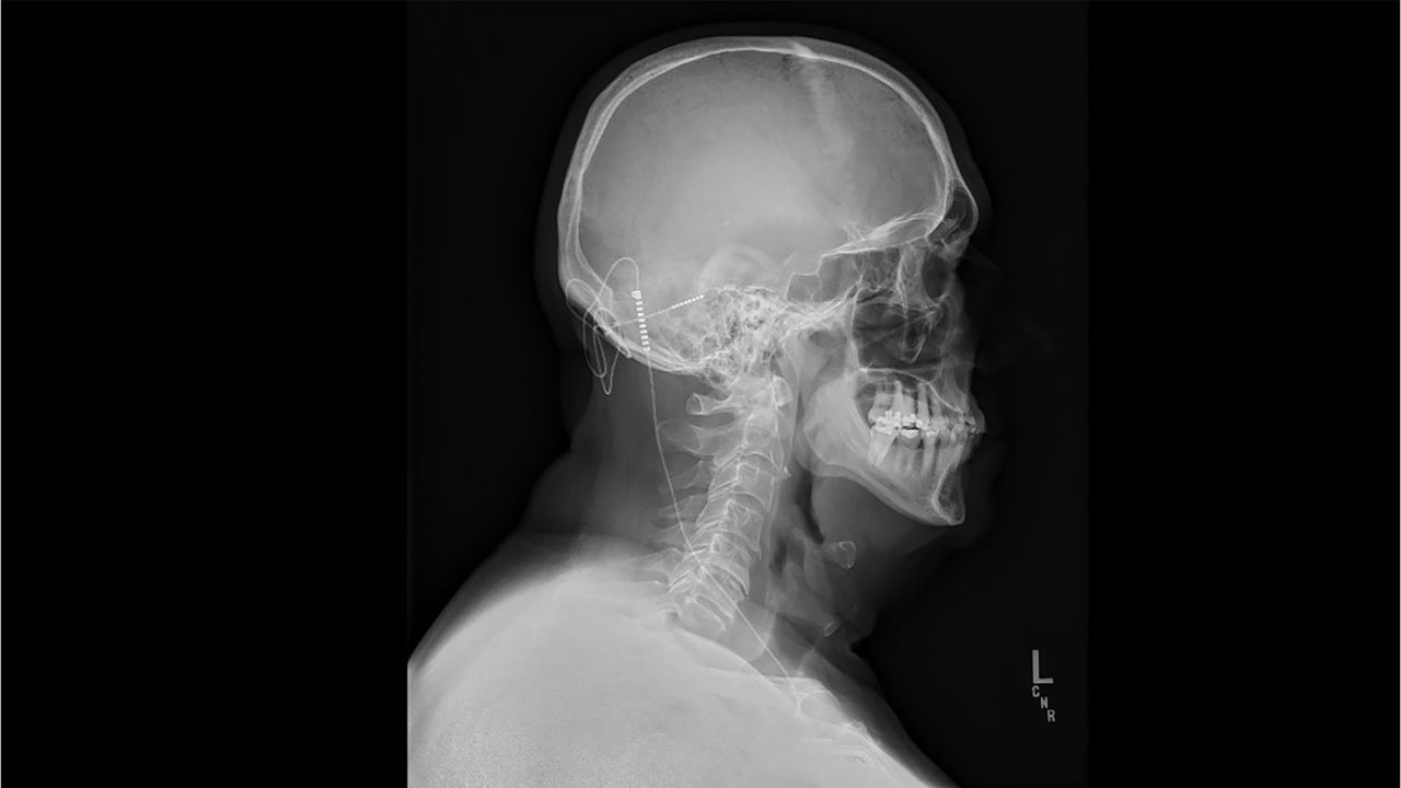 De operatie van Nicholas omvatte het plaatsen van een draad in het cerebellum, verbonden met een klein apparaatje onder de huid van zijn borst.