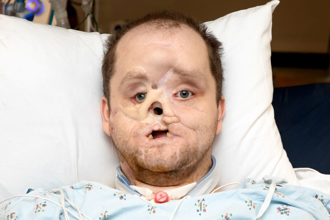 Before his face transplant surgery, Derek Pfaff was missing several parts of his face.