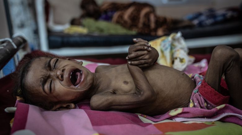 AL-BULUK HOSPITAL, OMDURMAN,​SUDAN.​ April 26, 2025.  Two-year-old Mohamed Maysara, who was admitted from a recently liberated area of Khartoum, lies on a gurney in one of Al-Buluk Hospital's severe malnutrition wards in Omdurman. Al-Buluk was Khartoum's only functioning pediatric hospital during the two-year civil war that began in April 2023.