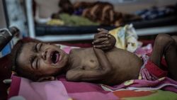 AL-BULUK HOSPITAL, OMDURMAN,​SUDAN.​ April 26, 2025.  Two-year-old Mohamed Maysara, who was admitted from a recently liberated area of Khartoum, lies on a gurney in one of Al-Buluk Hospital's severe malnutrition wards in Omdurman. Al-Buluk was Khartoum's only functioning pediatric hospital during the two-year civil war that began in April 2023.
