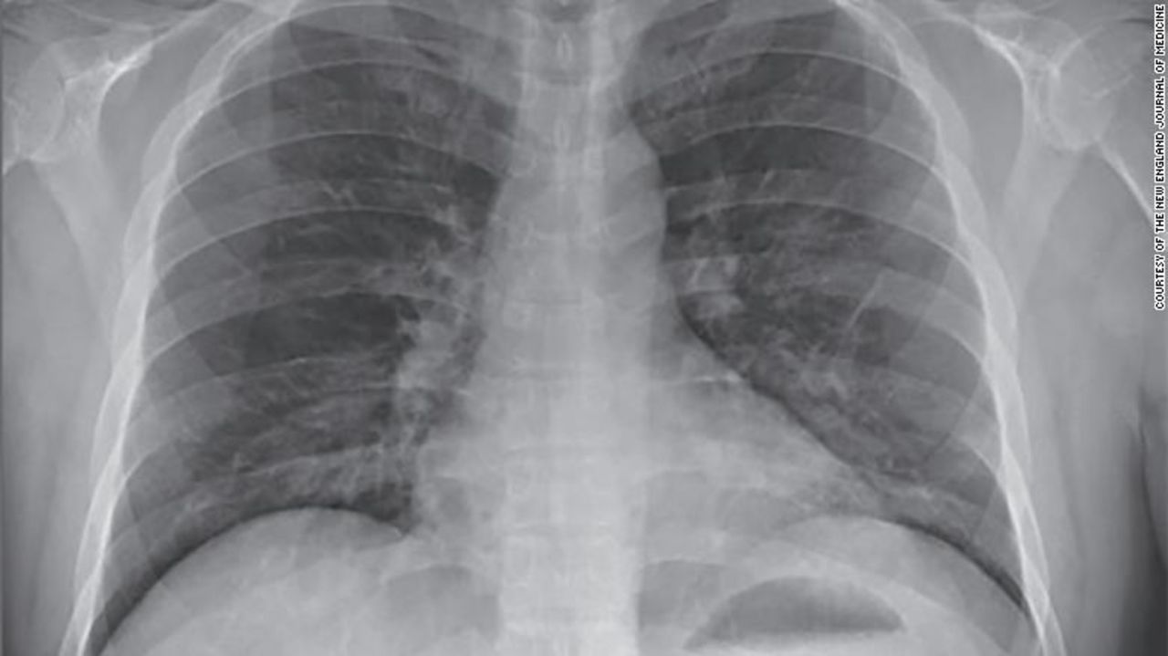 On his fifth day in the hospital, doctors saw signs of pneumonia in the coronavirus patient's lungs.