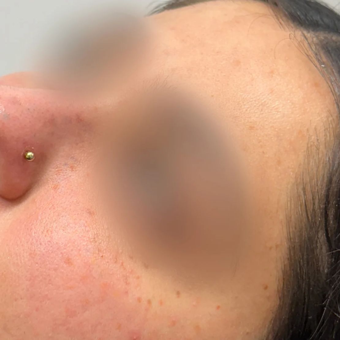 Ahora, casi han desaparecido y ya no tiene que usar maquillaje recargado para disimular las manchas. (Esta foto fue difuminada intencionalmente por CNN).