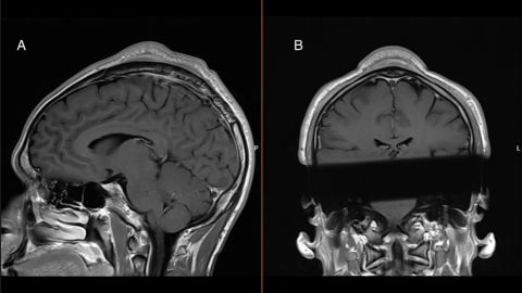 An MRI of a breaker's head shows the tumor that doctors believe developed due to repeated headspins.