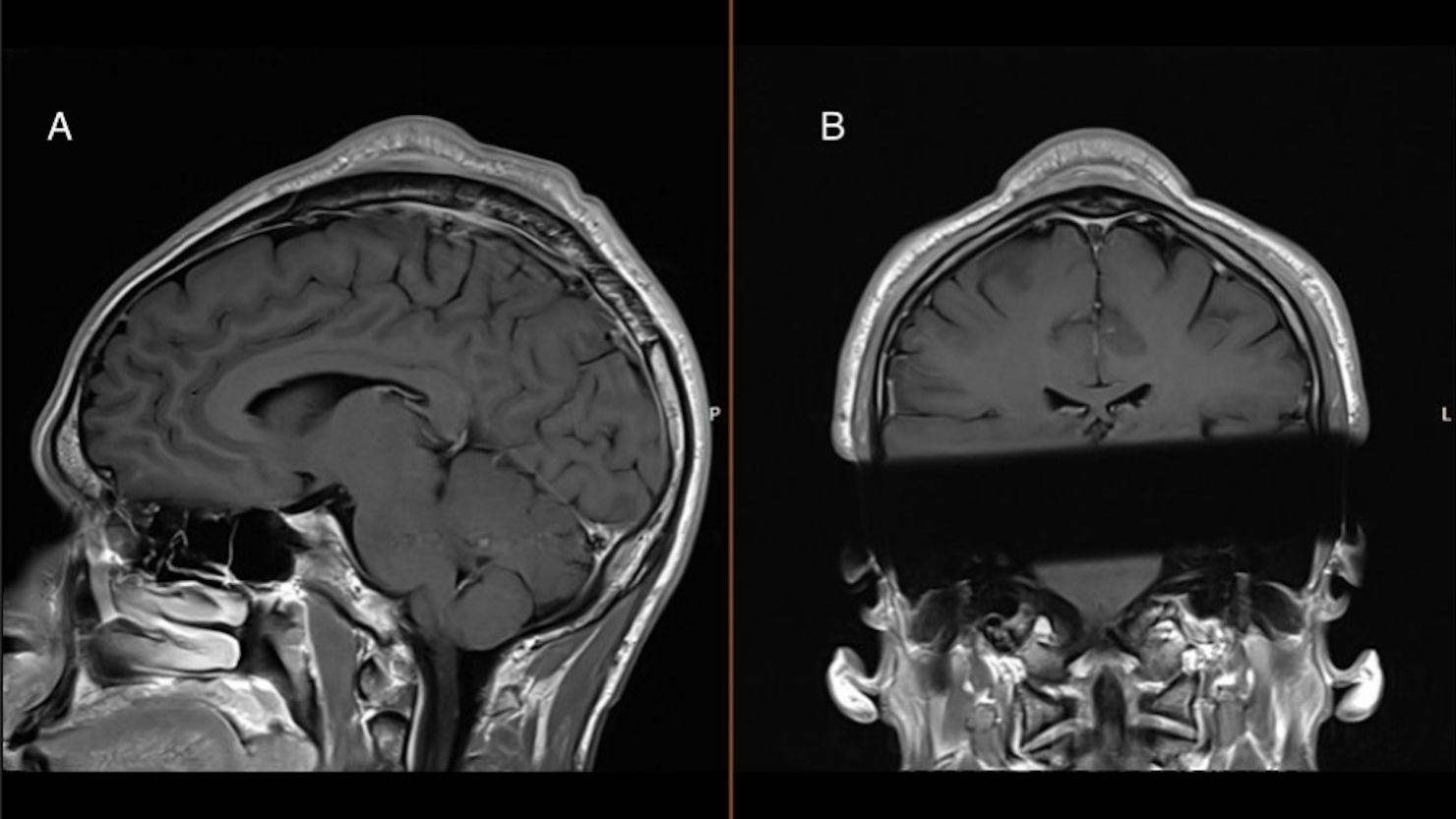 headspin-hole-man-develops-scalp-tumor-after-decades-of-breakdancing