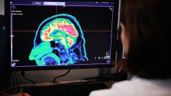 A picture of a human brain taken by a positron emission tomography scanner, also called PET scan, is seen on a screen on January 9, 2019, at the Regional and University Hospital Center of Brest (CRHU - Centre Hospitalier Régional et Universitaire de Brest), western France. The CHRU of Brest has just acquired a new molecular imaging device, the most advanced in France today according to the hospital center, capable of better detecting deep lesions and especially cancerous pathologies, the hospital announced on January 9, 2019. (Photo by Fred TANNEAU / AFP) (Photo by FRED TANNEAU/AFP via Getty Images)