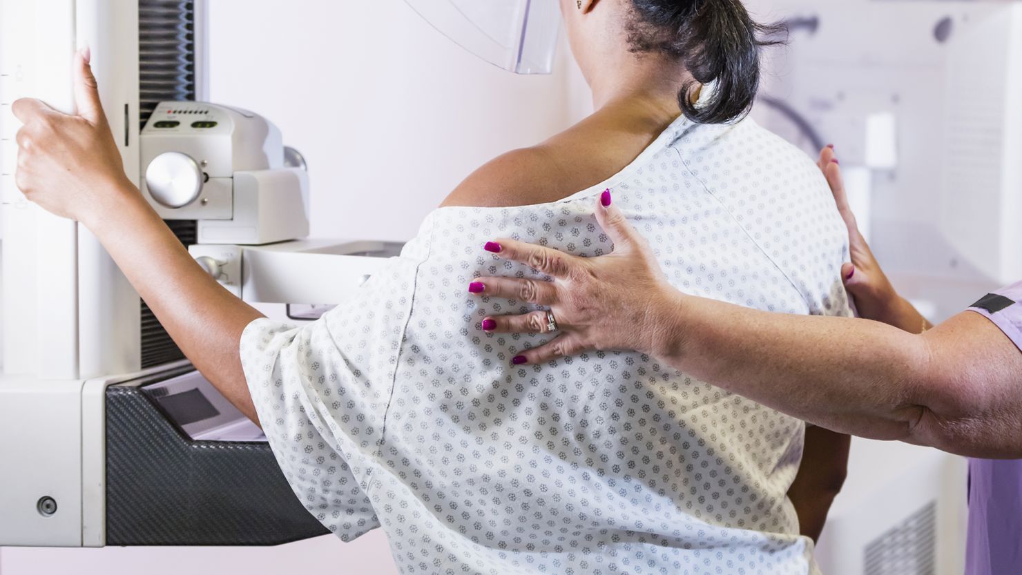 A new American Cancer Society report says that breast cancer incidence in the United States continued an "upward trend," rising 1% annually from 2012 to 2021.