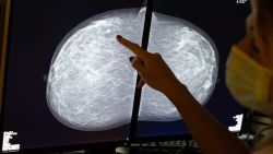 Illustration shows a mammography at the breast clinic of Saint-Jean Clinique - Sint-Jan Kliniek in Brussels, during the fight against the Covid-19 pandemic, Friday 16 October 2020. BELGA PHOTO BENOIT DOPPAGNE (Photo by BENOIT DOPPAGNE/BELGA MAG/AFP via Getty Images)