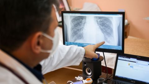 Bulgarian doctor and pulmonologist Alexander Simidchiev looks at an X-ray of lungs in the Medical Institute of Ministry of Internal Affairs in Sofia, on November 26, 2020. - Winter smog season has settled in and Bulgaria's soaring coronavirus death rate, one of Europe's highest, is prompting experts to warn about a compound health risk from air pollution and Covid-19. (Photo by NIKOLAY DOYCHINOV / AFP) (Photo by NIKOLAY DOYCHINOV/AFP via Getty Images)