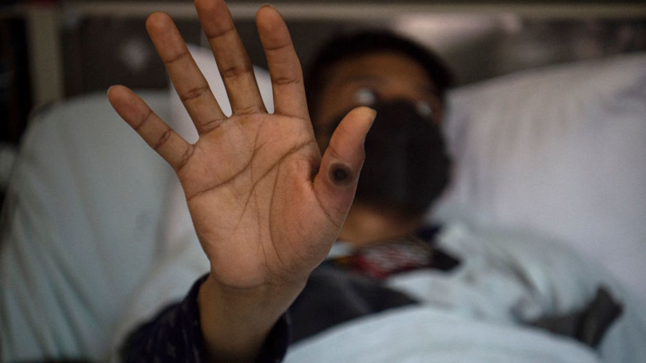 TOPSHOT - A patient shows his hand with a sore caused by an infection of the monkeypox virus, in the isolation area for monkeypox patients at the Arzobispo Loayza hospital, in Lima on August 16, 2022. Nearly 28,000 cases have been confirmed worldwide in the last three months and the first deaths are starting to be recorded. (Photo by Ernesto BENAVIDES / AFP) (Photo by ERNESTO BENAVIDES/AFP via Getty Images)