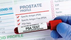 PSA blood test sample to screen for prostate cancer