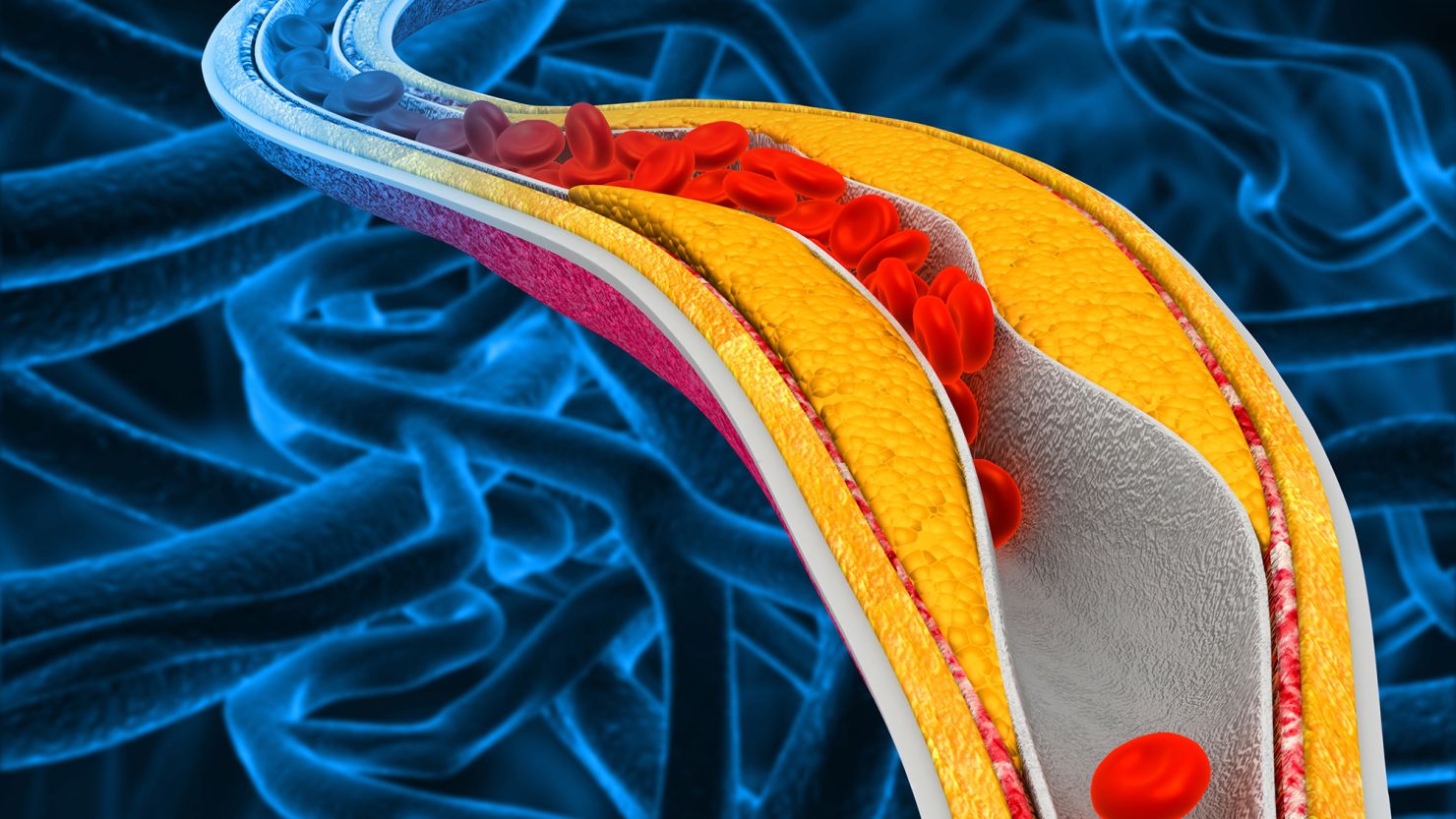 Heavy metals found in drinking water, air pollution and more may cause calcium buildup in coronary arteries that causes a chronic inflammatory condition, according to new research.