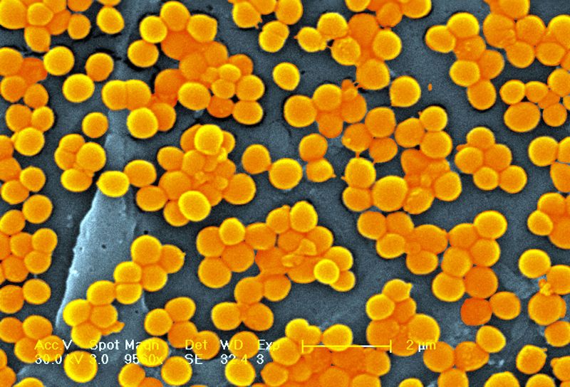 Superbug Crisis Threatens Millions of Lives by 2050