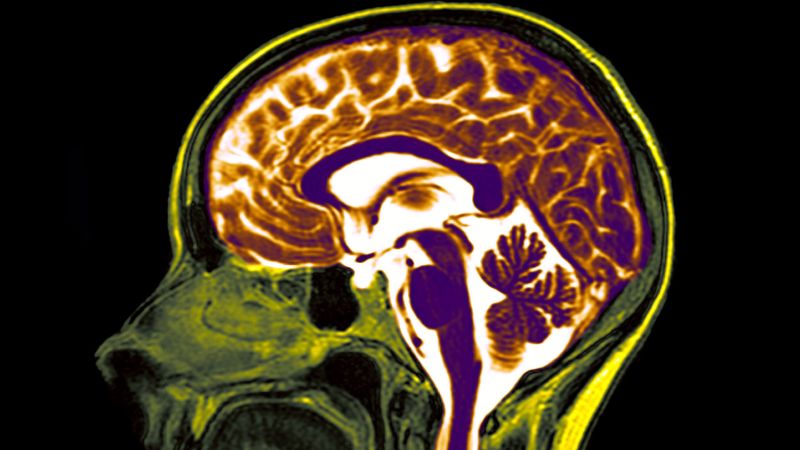 Стартъпът Neuralink на Илон Мъск имплантира компютърен чип в мозъка
