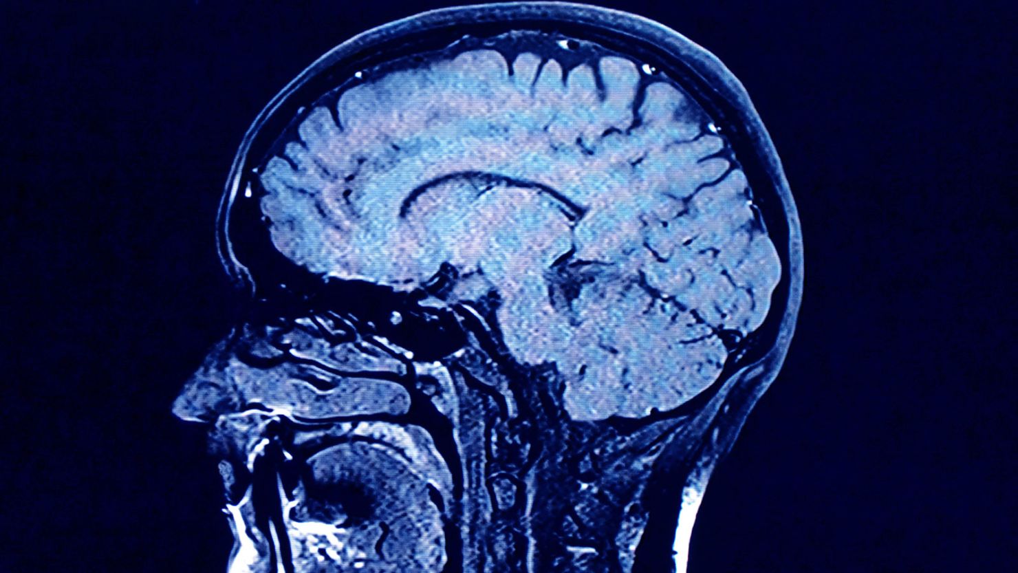 Researchers find that both genetic influences and lifestyle factors can affect an aging brain.