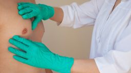 a doctor in green gloves examines a man's chest. Prevention of breast diseases in men. Men's health