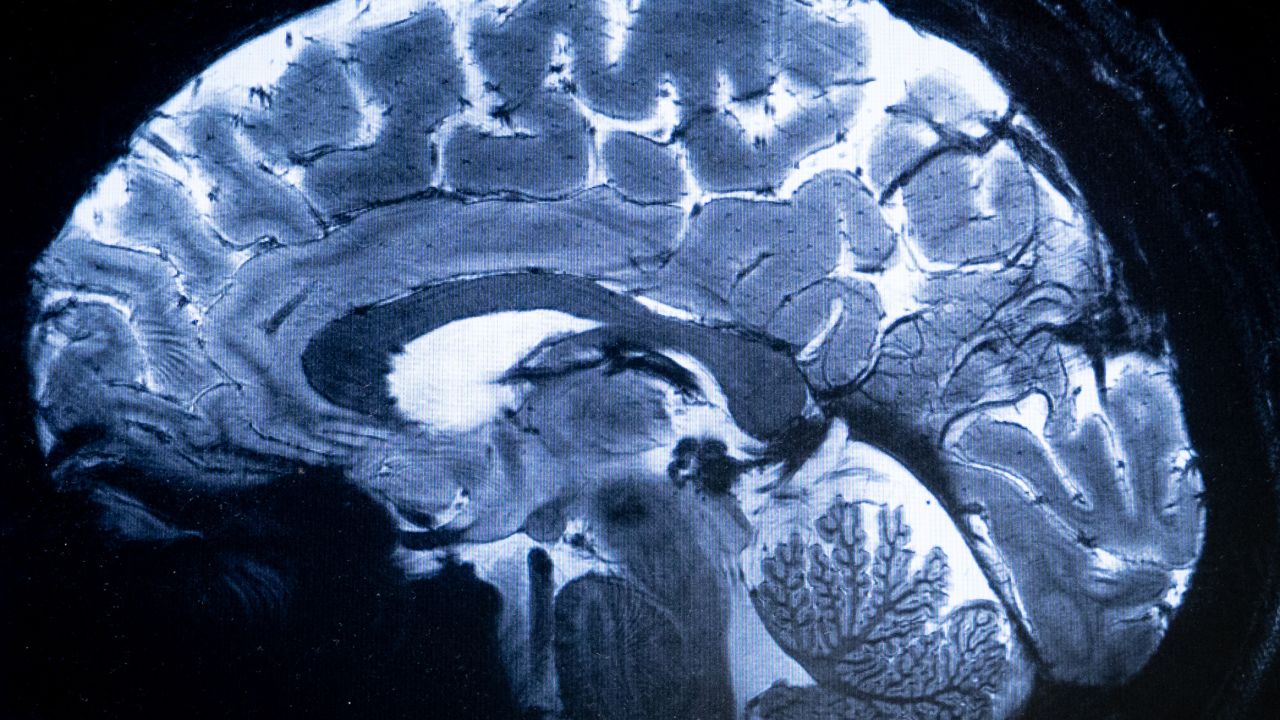 This image made with the Iseult Magneton 11.7 T MRI shows a brain during a magnetic resonance imaging (MRI) exam simulation at the Neurospin facilities in the Paris-Saclay Alternative Energies and Atomic Energy Commission (CEA - Commissariat a l'energie atomique et aux energies alternatives) centre in Gif-sur-Yvette, on March 22, 2024. "Iseult", the world's most powerful MRI scanner, has delivered its first images of the human brain and is expected to provide a better understanding of its functioning and of certain neurodegenerative and psychiatric diseases. The technical feat is the result of a French-German partnership which has required more than 20 years of research. (Photo by Alain JOCARD / AFP) (Photo by ALAIN JOCARD/AFP via Getty Images)