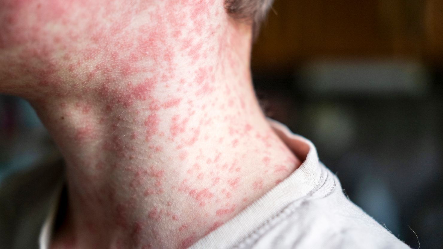 About 1 in 5 unvaccinated people in the US who get measles will be hospitalized, according to the CDC.
