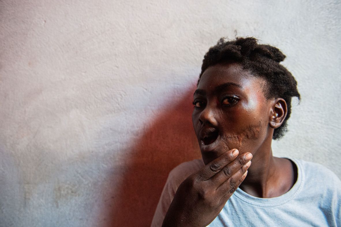Lovely Jean Baptiste, a 16-year-old who was shot in the mouth by armed gangs, poses for a portrait Thursday, July 17, at the Argentine Bellegarde School, which has been turned into a shelter for displaced people in Port-au-Prince, Haiti.