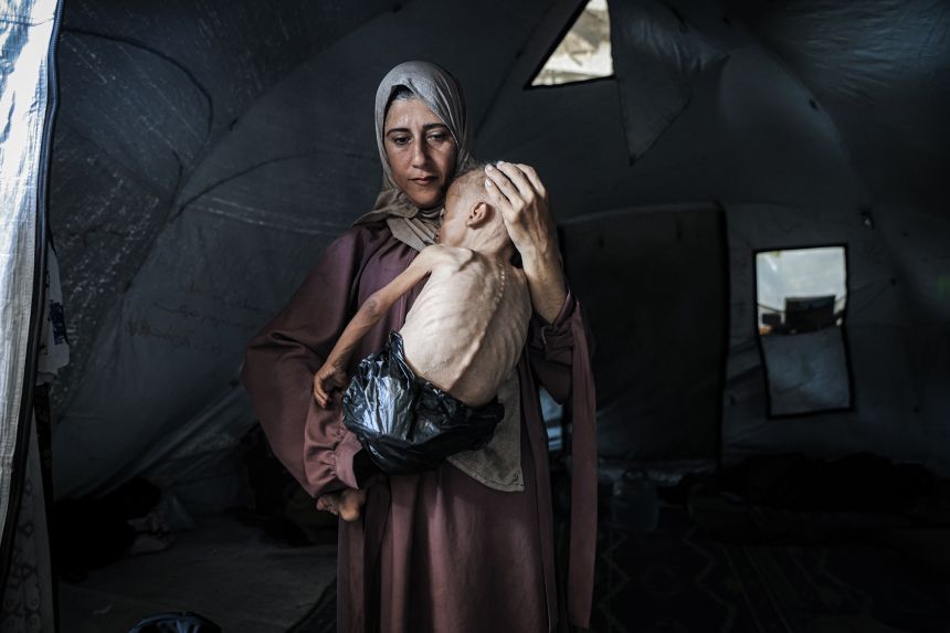 Muhammad Zakariya Ayyoub al-Matouq, a 1.5-year-old child pictured on July 21 in Gaza City, Gaza, faces life-threatening malnutrition due to ongoing Israeli attacks and blockade.