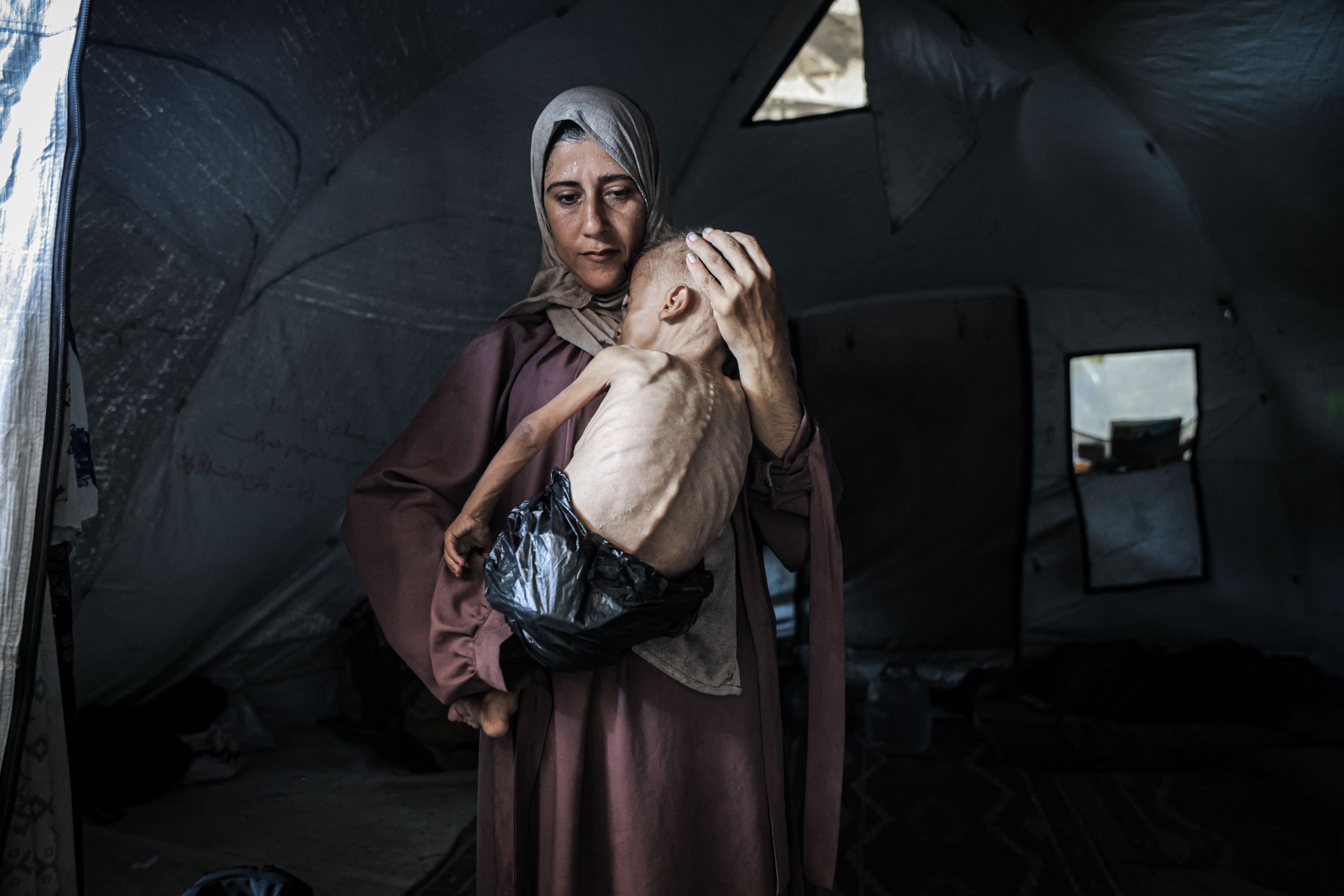 Muhammad Zakariya Ayyoub al-Matouq, a child in Gaza City, is held on July 21. He has a muscle disorder that requires physical therapy and specialized nutrition, and he faces life-threatening malnutrition as the humanitarian situation worsens due to ongoing Israeli attacks and the blockade. Having dropped from 9 to 6 kilograms (approximately 20 to 13 pounds), he struggles to survive in a tent.