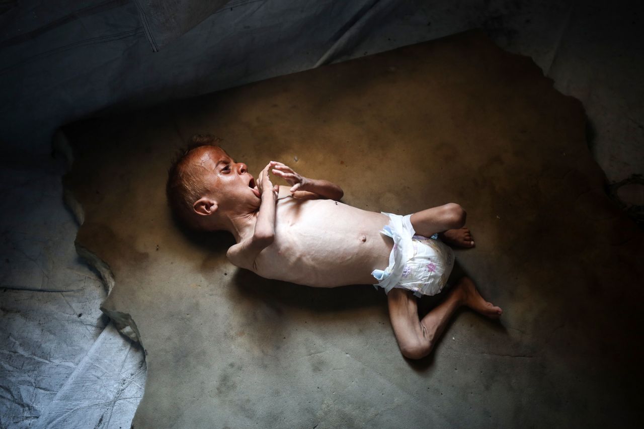 Mohammed al-Mutawaq, an 18-month-old Palestinian boy with medical issues and signs of malnutrition, lies on a mattress inside a tent at the Al-Shati refugee camp west of Gaza City on July 25.
