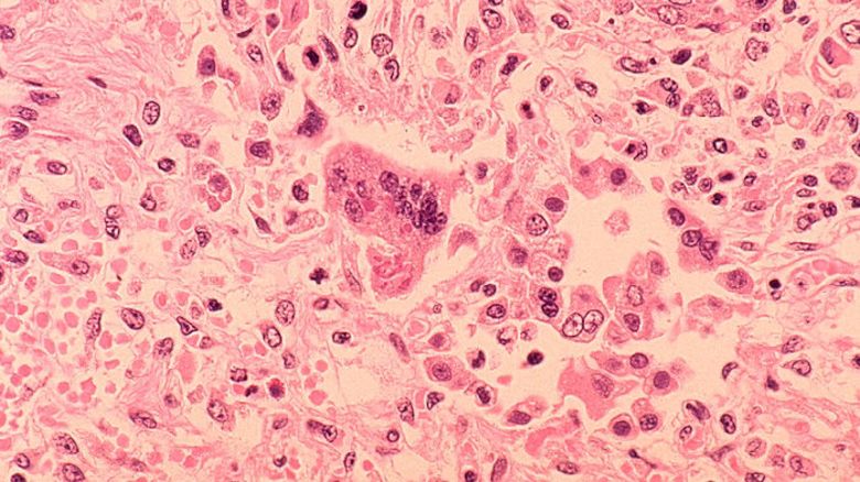 1972:  In this handout from the Centers for Disease Control and Prevention (CDC), a histopathology of measles pneumonia is seen in this microscope image from 1972. Measles outbreaks have been reported throughout the U.S., with the latest reported February 5, 2015 at a daycare in suburban Chicago where as many as five children under the age of one have been infected. (Photo by CDC via Getty Images)