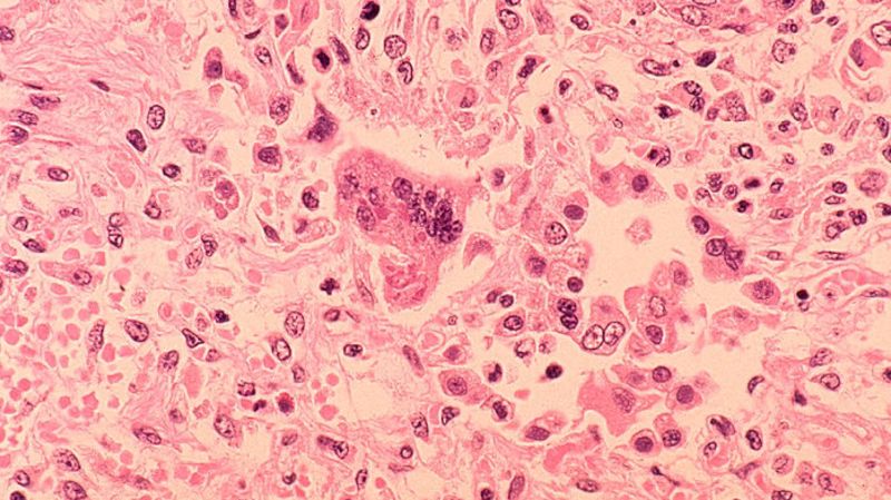North Dakota Measles Scare: Hundreds of Unvaccinated Students Quarantined as Cases Rise
