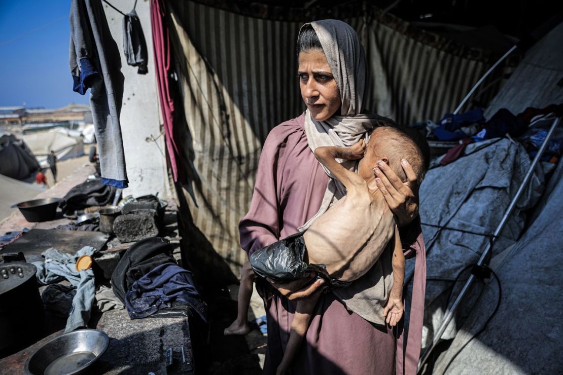 Muhammad Zakariya Ayyoub al-Matouq, de un año, se enfrenta a una desnutrición potencialmente mortal mientras la situación humanitaria empeora en Gaza, el lunes.