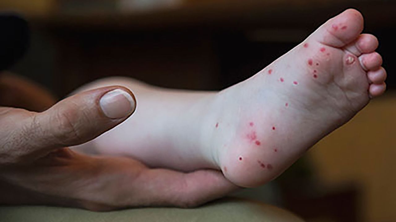 A rash on the palms and soles is a common sign of HFMD.