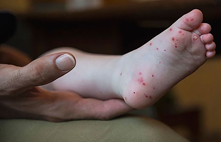 A rash on the palms and soles is a common sign of hand, foot and mouth disease.