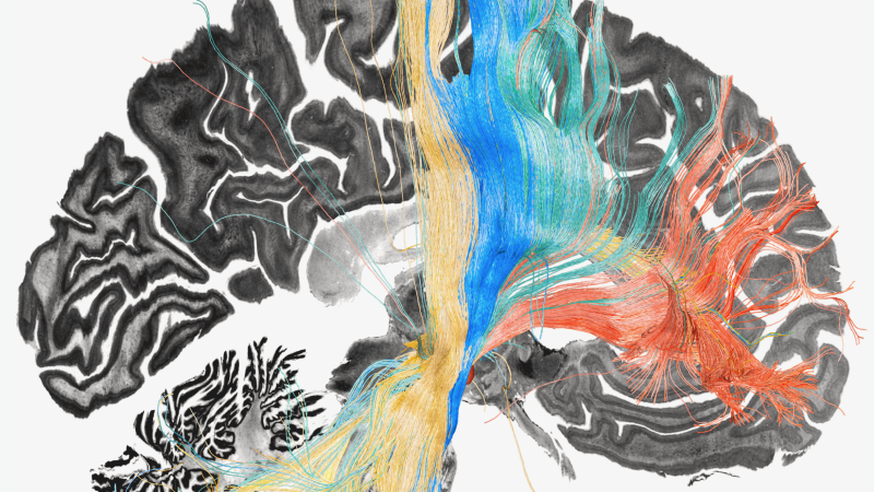 Дълбоката мозъчна стимулация не проработи при млад пациент с ОКР, докато новите мозъчни карти не промениха всичко