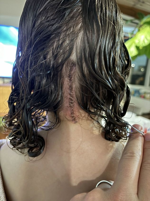 In September 2023, Juliette had a tumor resected from her brainstem.
