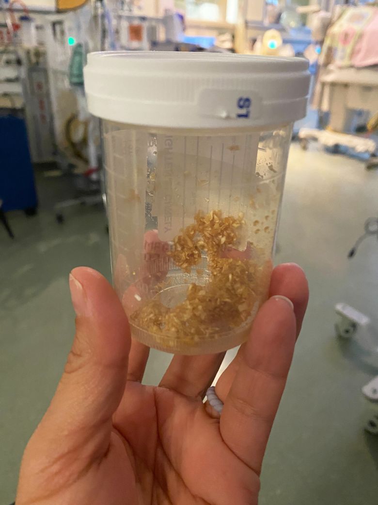 A mixture of fish skin and honey was applied to Eliana's wound.