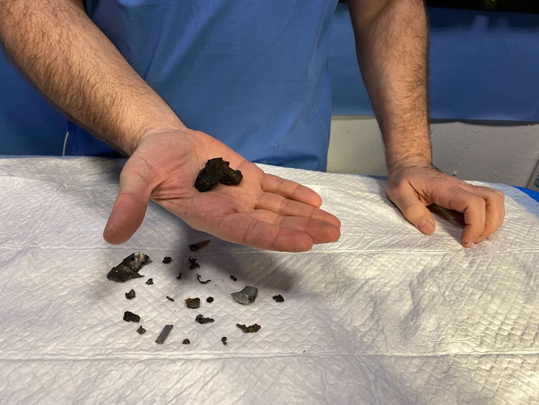 Dr. Sviatoslav Mykytiuk shows CNN fragments of shrapnel he removed from the bodies of wounded Ukrainian soldiers.