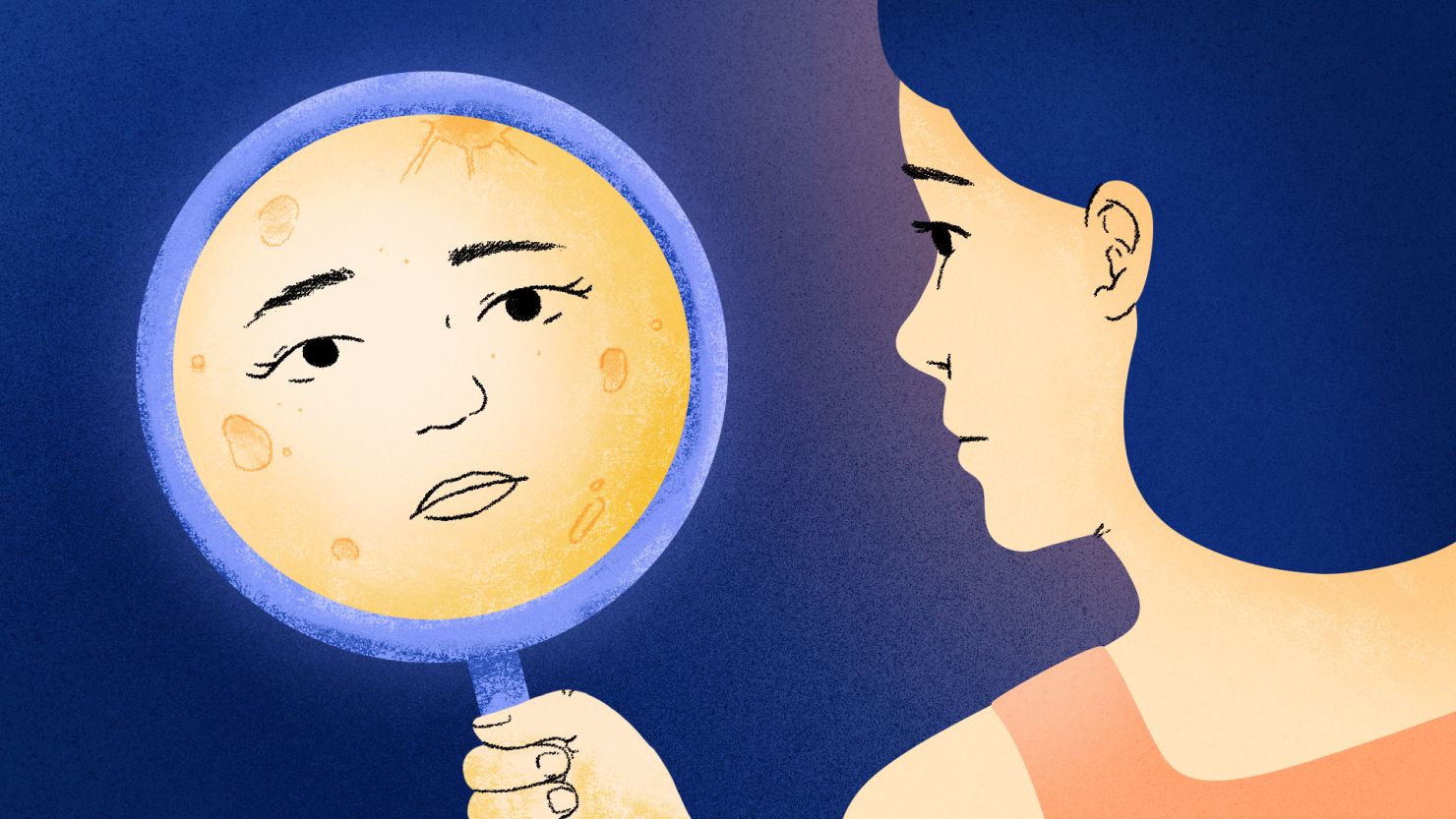 Dermatologists cast doubt on chatter among social media users that high levels of the stress hormone cortisol can lead to puffy or rounded cheeks, a condition that’s been dubbed “moon face.”