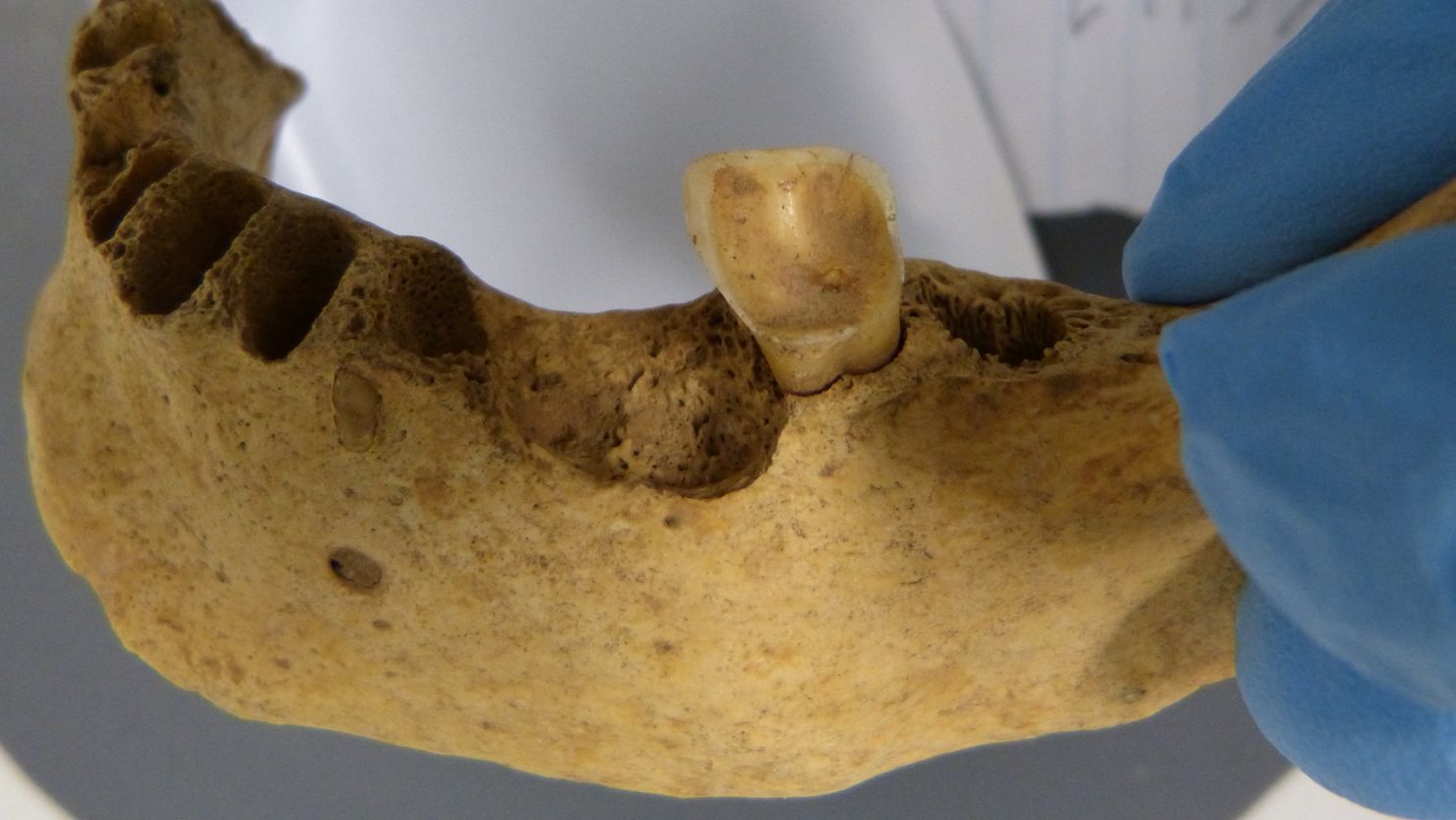 Uncovered in a limestone cave in Ireland, an ancient tooth from 4,000 years ago was found to have an abundance of a cavity-causing bacteria that is rare in the ancient genomic record.