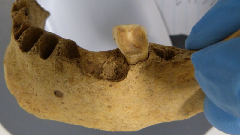 Редки древни бактерии, открити върху зъбите от бронзовата епоха, разкриват въздействието, което ключова промяна в диетата е оказала върху човешкото здраве